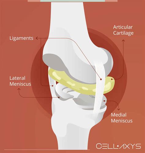 How To Treat Knee Pain That Persists One Year After Meniscus Surgery ...