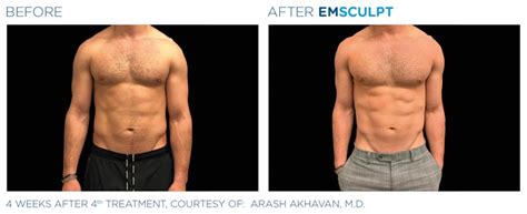 Emsculpt® Body Toning for Los Gatos, Campbell, Saratoga & Cupertino, CA ...