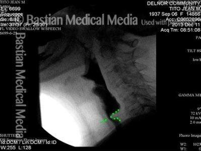 Cricopharyngeal Myotomy (CPM) | Treatment for A/R-CPD