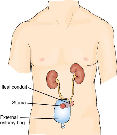 Bladder Removal Surgery: What is a Cystectomy? | BCAN