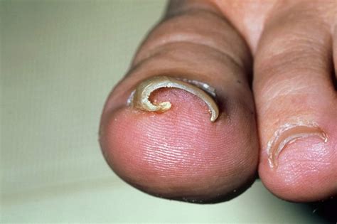 Take Care of Ingrown Toenails with Foot & Ankle Surgical Associates - ThurstonTalk