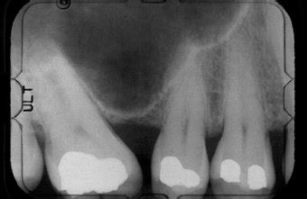 Do Dental X-rays Show Periodontal Issues? | Chron.com