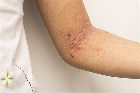 Dermatitis Atopik - Gejala, Penyebab, dan Pengobatan - Alodokter