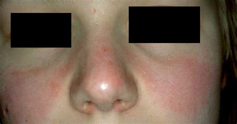 Lupus Rash - Pictures, Symptoms, Causes, Treatment - (2018 - Updated)