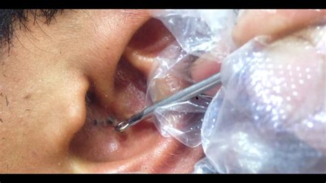 Blackheads in ear | ear blackheads removal | blackheads 2020 - YouTube