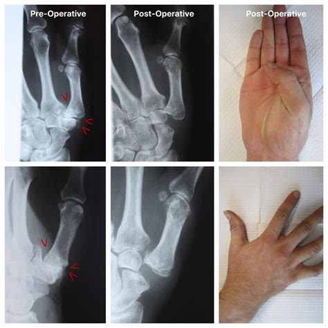 Thumb Arthritis Treatment in Raleigh by Dr. Erickson