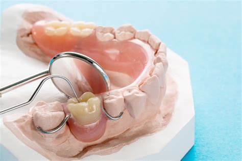 Partial Dentures - Trident Dental Lab