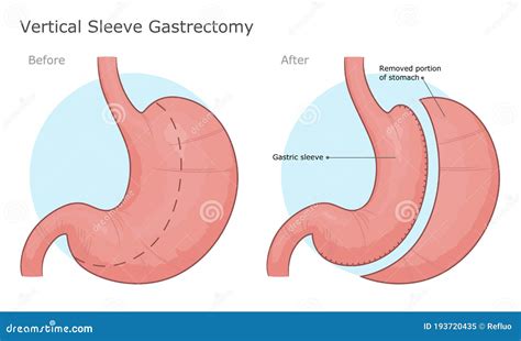 Vertical Sleeve Gastrectomy Surgery Illustration Stock Vector - Illustration of gastrectomy ...