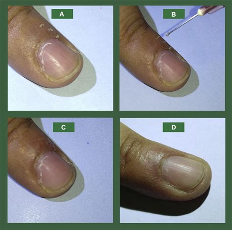 Hangnail: A simple solution to a common problem - Journal of the American Academy of Dermatology