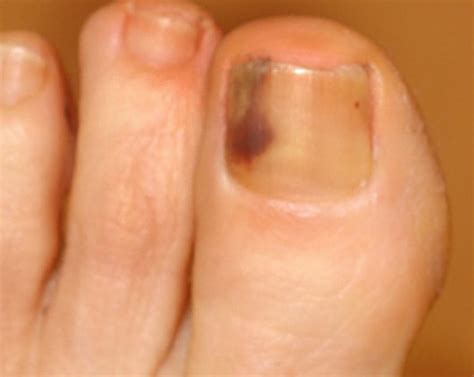 Melanoma Under Nail Bed Photos - Nail Ftempo