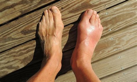 Gout Relief: An Alternative to Drugs - Sweeter Living