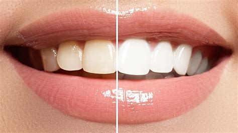 How Does Teeth Whitening Work? | Colgate MY