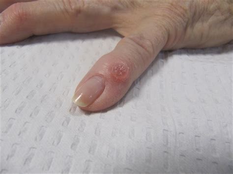 A blister-like lesion on the finger - Clinical Advisor