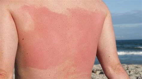 Could you be allergic to sunscreen? - Skin Essentials