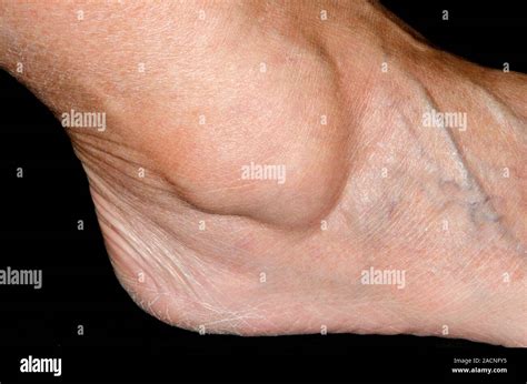 Large swelling over the ankle in a 76 year old female patient due to a ganglion (cyst), a fluid ...