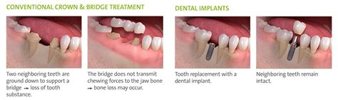 How Much Does It Cost To Replace A Missing Tooth | Renew Physical Therapy