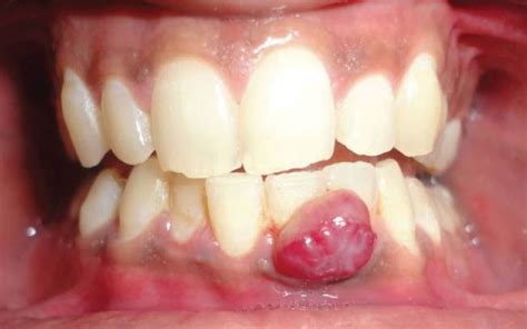 Pyogenic Granuloma In Pregnant Women