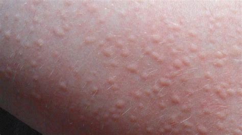 What Is Urticarial Rash | Allergy Trigger