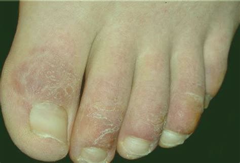 Chilblains - Pictures, Symptoms, Treatment, Causes