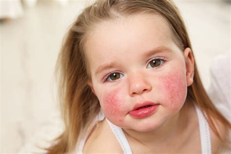 Can Your Children Get Allergy Hereditarily?