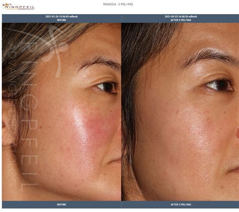Acne Rosacea Before After