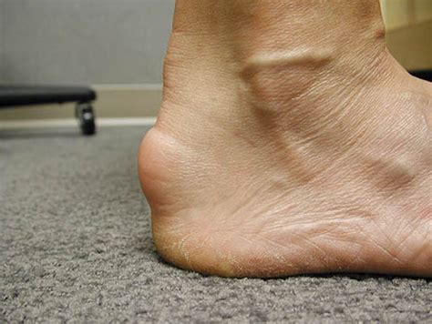 Achilles tendonitis - Definition of Achilles tendonitis