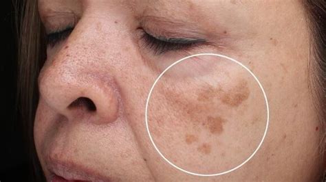 Age Spots - no need to keep them. Ways to prevent or remove age spots ...