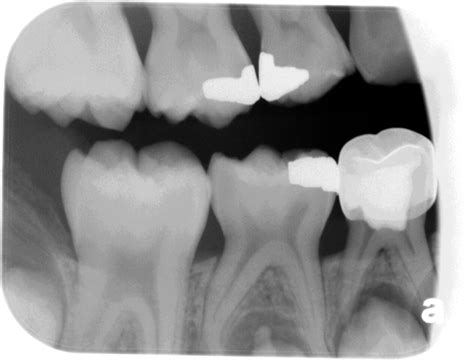 Case of the Week: Dens Evaginatus – Dr. G's Toothpix