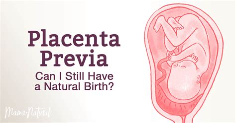 Placenta Previa: Can I Still Have a Natural Birth? | Mama Natural