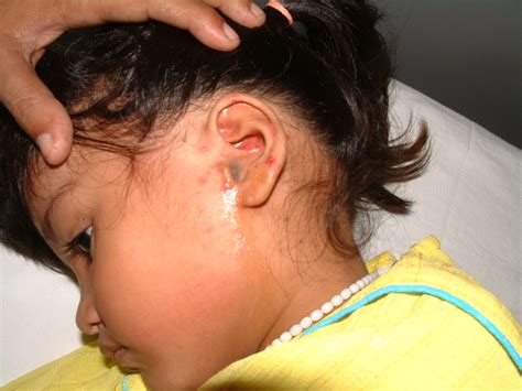 ENT Surgeon's blog: Removing maggots from a 4 yr girl's ear