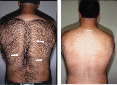 Full Back Laser Hair Removal in Phoenix, AZ | Suddenly Slimmer Med Spa