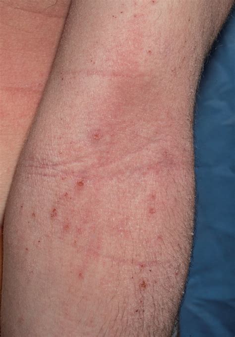 Eczema Bumps On Arms
