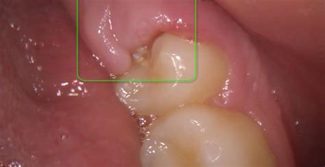 Pericoronal Abscess