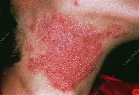Skin Fungal Infection Rash