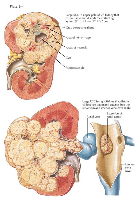 RENAL CELL CARCINOMA - pediagenosis