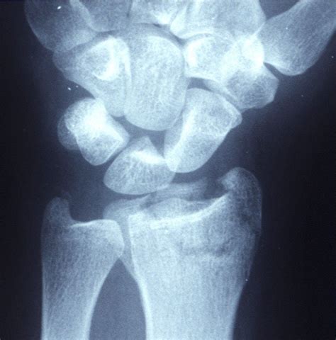 File:Displaced distal radius fracture.jpg - Wikimedia Commons
