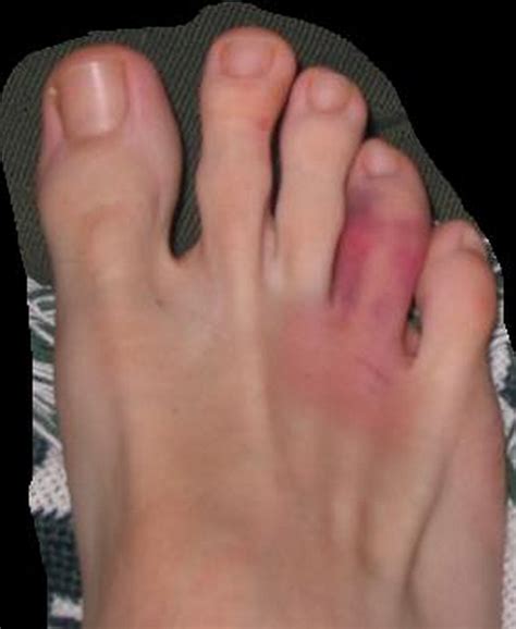 Healthool Sprained Toe Symptoms Vs Broken Big Toe Treatment | Images and Photos finder