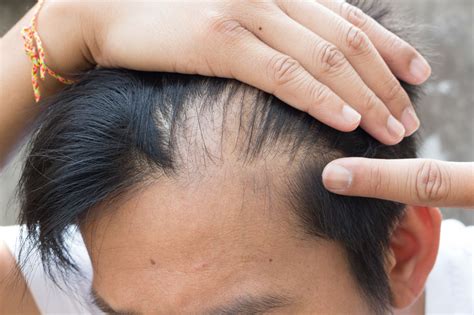 What Is Male Pattern Baldness and Can It Be Treated? - Hair & Skin Science