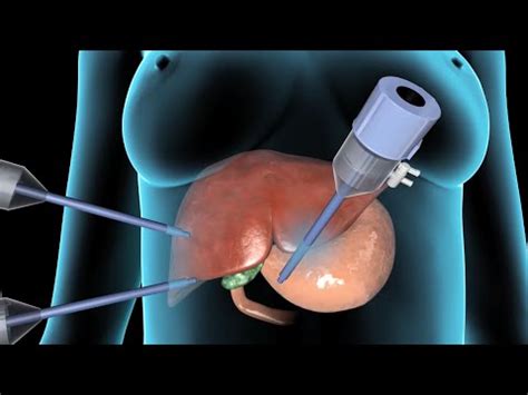 Cholecystectomy | Gallbladder Removal Surgery | Nucleus Health - Uohere