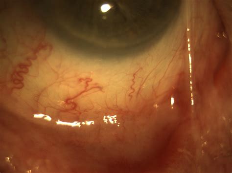 Ocular Cicatricial Pemphigoid - MERSI