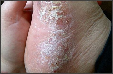 Pustular Psoriasis On Feet Pictures Symptoms And Pictures | SexiezPicz ...