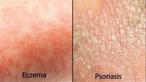 Eczema vs Psoriasis – Which One Do I Have? – Ultra Bee™