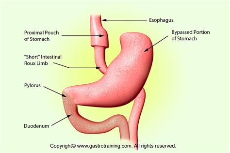 Gastroenterology Education and CPD for trainees and specialists » Roux-en-Y gastric bypass