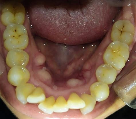 Torus mandibular-¿qué es un rodete mandibular? – hr-dental.com