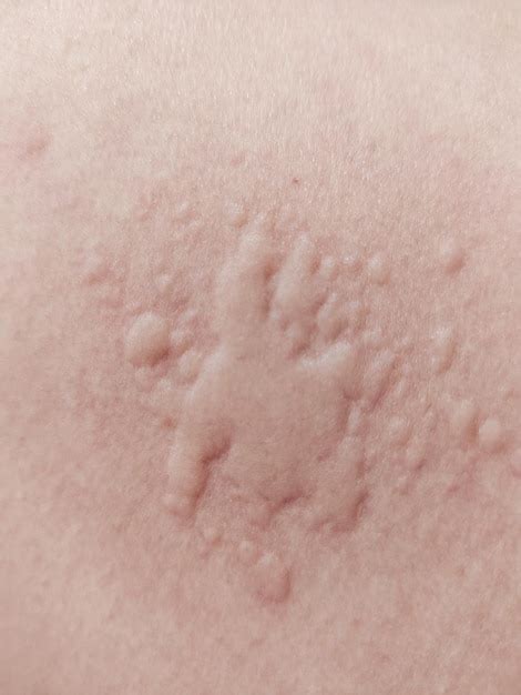 Premium Photo | Red rash on the skin caused by allergies