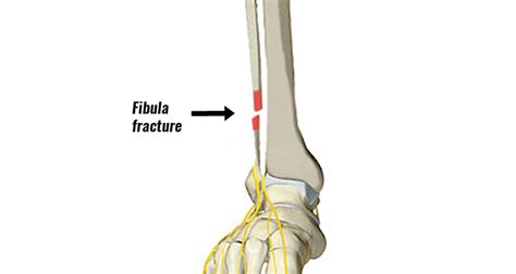 Fibula Fracture - Types, Symptoms, Causes and Rehabilitation