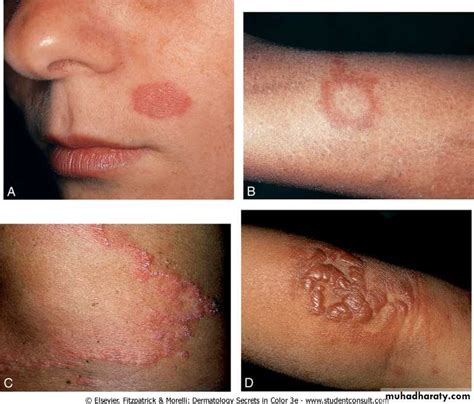 Tuberculoid Leprosy Symptoms