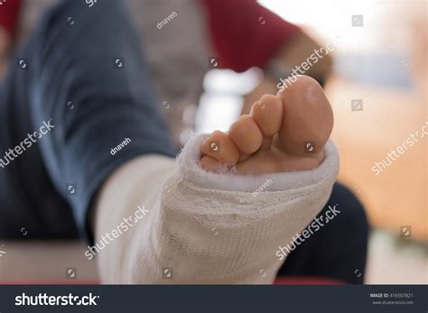 Young Man Broken Ankle White Cast Stock Photo 416507821 | Shutterstock