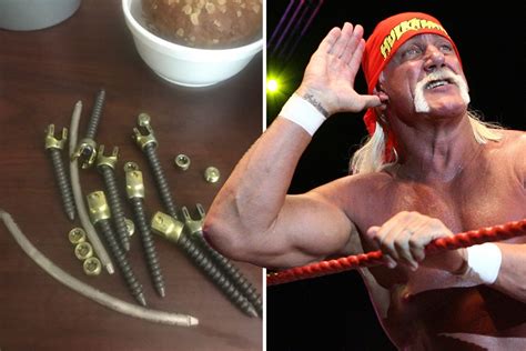 WWE legend Hulk Hogan shares picture of huge screws he had in his back after undergoing surgery ...