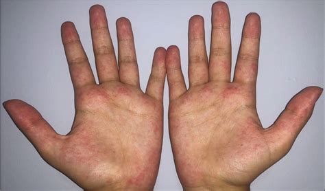 A case series and literature review of erythema palmare hereditarium ...